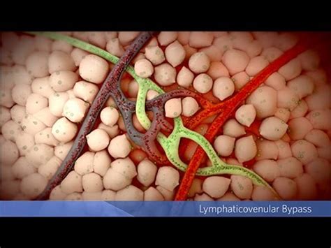 lv bypass|Q&A: Lymphaticovenous Bypass to Tre.